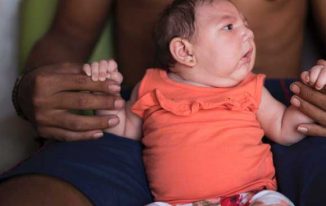 zika-baby-birth-defects