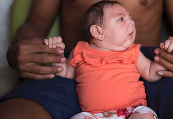 zika-baby-birth-defects