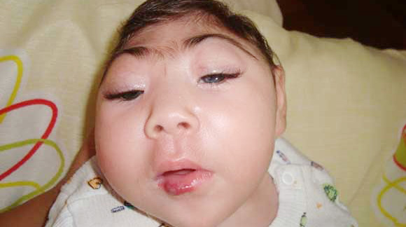 zika-virus-baby-birth-defects1A